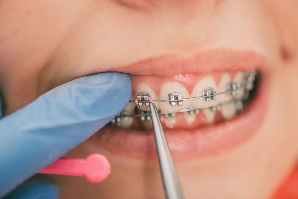 Featured image for “Braces Care Tips from a Professional Orthodontist”