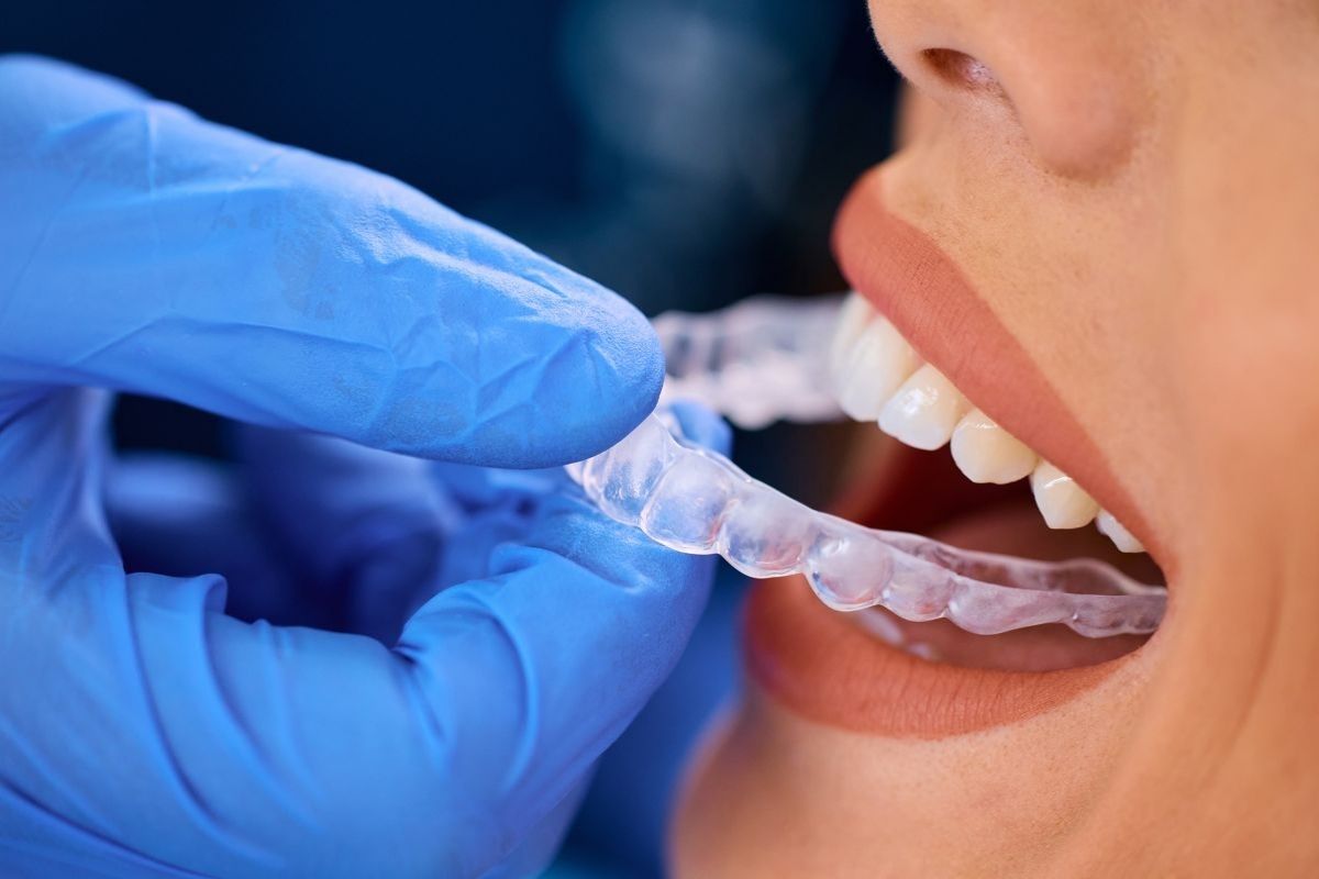 Featured image for “Invisalign Aligners Won’t Stay On? Causes and Easy Fixes”