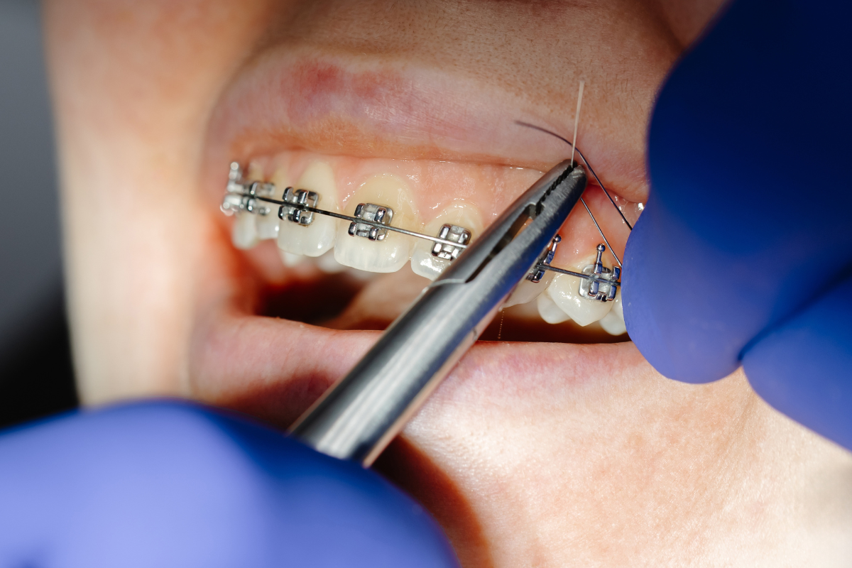 Featured image for “A Clear Breakdown of Braces Treatment Options in McMurray”
